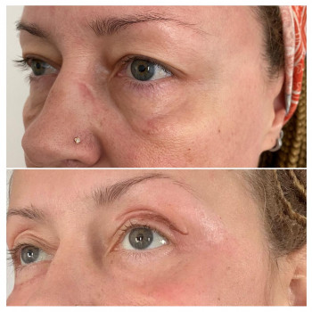 Блефаропластика без хірурга
                    Врач-косметолог Майя Киев