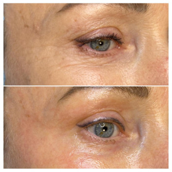 Блефаропластика без хірурга
                    Врач-косметолог Майя Киев