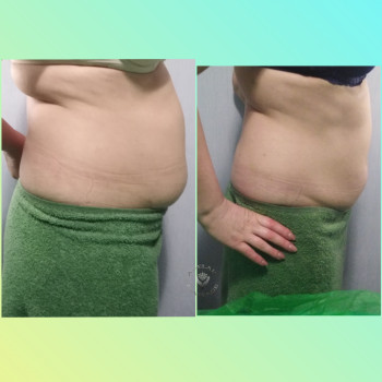 результат 4х процедур