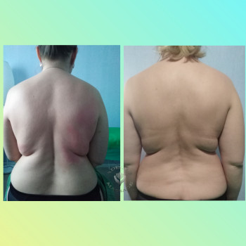 результат 3х процедур