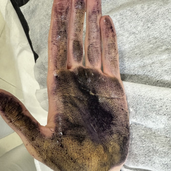 Лікування гіпергідрозу ботоксом