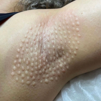 Гипергидроз стоп, ладоней, подмышек, внутр часть бедер
                    Косметолог Елена Одесса