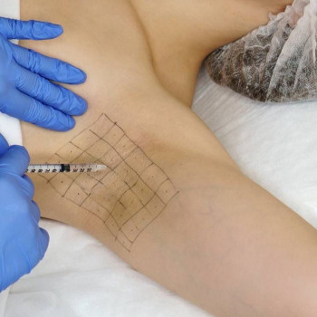 Гипергидроз стоп, ладоней, подмышек, внутр часть бедер
                    Косметолог Елена Одесса