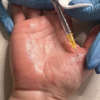 Гипергидроз стоп, ладоней, подмышек, внутр часть бедер
                    Косметолог Елена Одесса