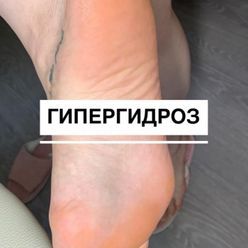 Гипергидроз стоп, ладоней, подмышек, внутр часть бедер
                    Косметолог Елена Одесса