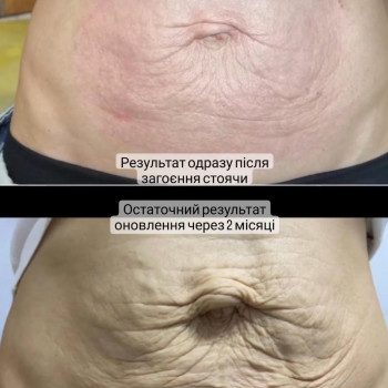 абдомінопластика живота #підтяжкадивота #стрії #сублімація