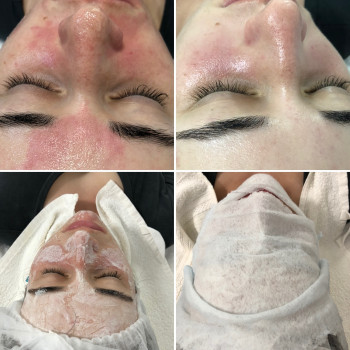 Чистка реактивної шкіри!)