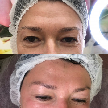 Результат після атравматичноі чистки!✅