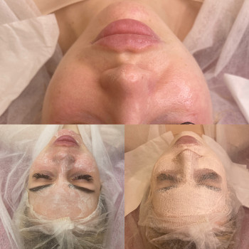 Комбінована чистка обличчя ?