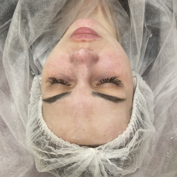 Комбинированная чистка лица
                    Косметолог-инъекционист Ирина Херсон