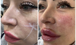 Радіес Косметолог-инъекционист Наталья Киев