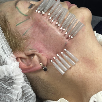 Омолодження обличчя нитковий ліфтинг #