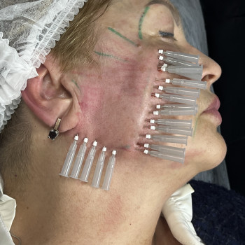 покращення якості шкіри нитками # на основі полімолочноі кислоти