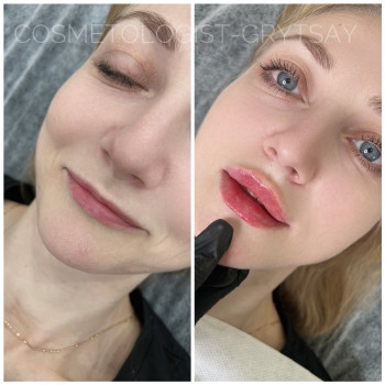 Первинна корекція губ #