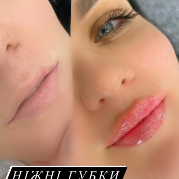 Контурна пластика -первинна процедура