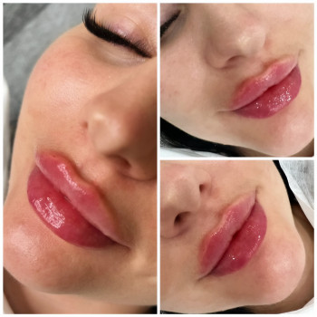 Бьютифікація губ #