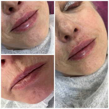 Омолодження # губ та периоральноі зони, , омолодженнякисета # 2 мл