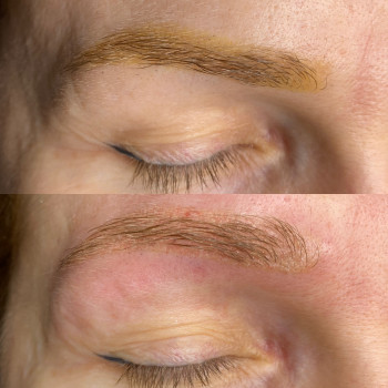 До видалення та одразу після