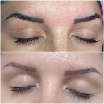 До видалення та загоєні після 1 процедури видалення