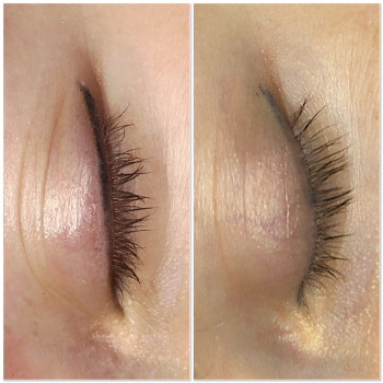 До видалення та загоєна після однієї процедури видалення ремувером