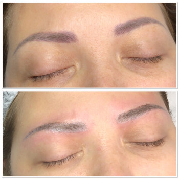 До та одразу після процедури видалення