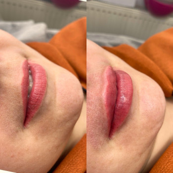 Контурна пластика губ