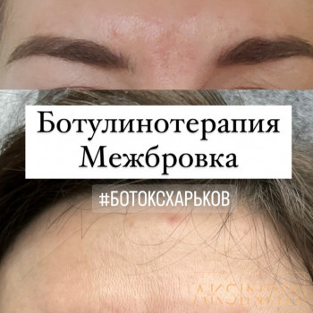 Ботокс @aksiniya_master_