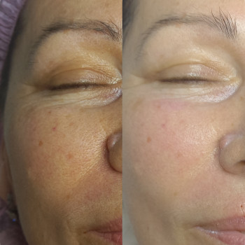 Догляд за обличчям Renew+пластифікуючий масаж обличчя
 
 
 