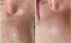 Чистка обличчя Casmara Салон красоты Sweet Skin Киев