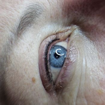 Міжвійка 
Межресничка