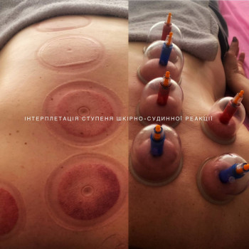 вакуумно-градієнтна терапія