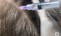 Мезотерапія волосся Hair Vital Косметолог  Львов