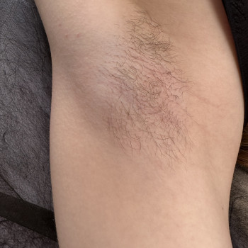 Електро Епіляція
                    Електролог Наталя Хмельницький