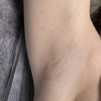 Електро Епіляція
                    Електролог Наталя Хмельницький