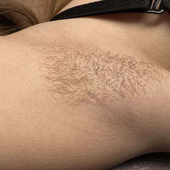 Електро Епіляція
                    Електролог Наталя Хмельницький