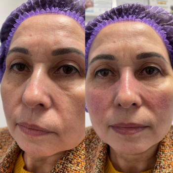 Полімолочна кислота
                    Косметолог-инъекционист Наталия Киев