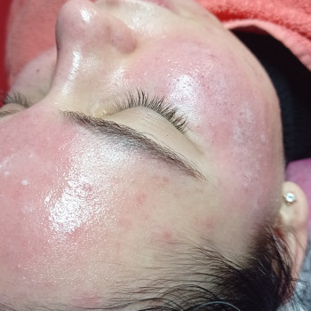 Азелаїновий пілінг