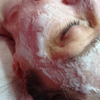 Карбоксітерапія