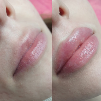 Збільшення губ
                    Косметолог Евгения Кривий Ріг