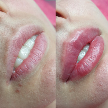 Збільшення губ
                    Косметолог Евгения Кривий Ріг