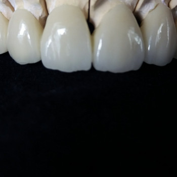 Керамічні коронкі