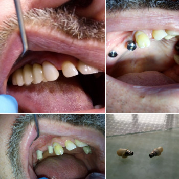 Циркониевий міст на індівідуальних цірконієвих абатментах
 