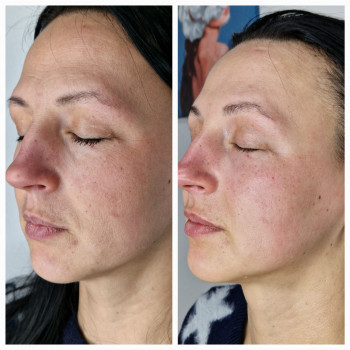 Ферментотерапія
                    Салон краси En Ajoure Київ