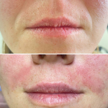 Корекція філлером носогубних складок