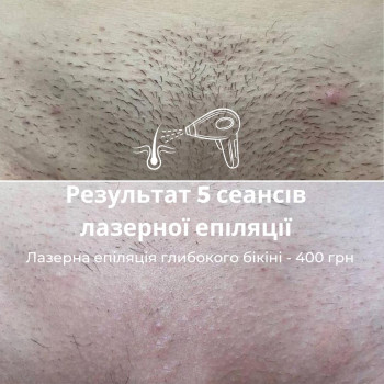 Комплекс лазерної епіляції №1 (ноги повністю + глибоке бікіни + пахви)
                    Салон красоты Мастерская Красоты "Юлии Юдиной" Киев