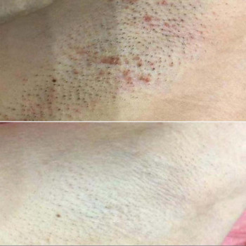 Комплекс лазерної епіляції №3 (глибоке бікіні + пахви+ гомілки + коліна + стегна частково + пальці на ногах по бажанню)
                    Салон красоты Мастерская Красоты "Юлии Юдиной" Киев