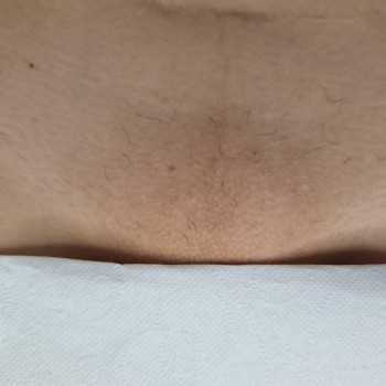 Комплекс лазерної епіляції №3 (глибоке бікіні + пахви+ гомілки + коліна + стегна частково + пальці на ногах по бажанню)
                    Салон красоты Мастерская Красоты "Юлии Юдиной" Киев