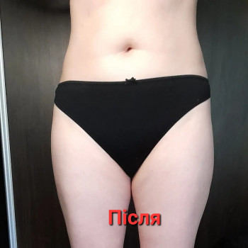 Антицелюлітний масаж
                    Масажист Ольга Харків