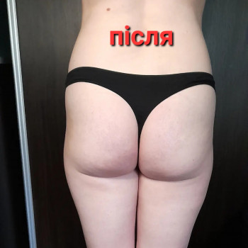 Антицелюлітний масаж
                    Масажист Ольга Харків