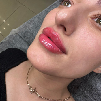 Збільшення губ